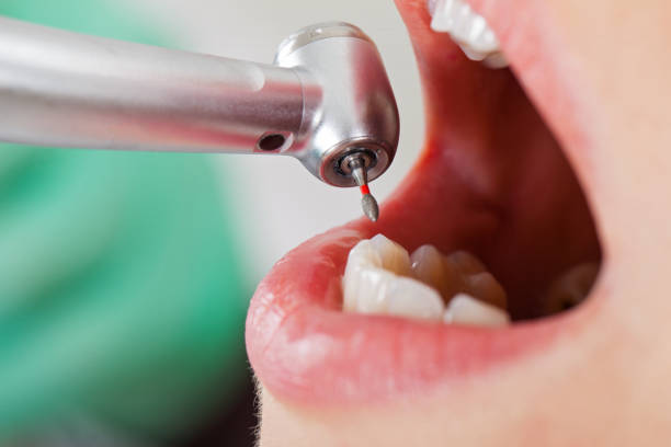 Best Emergency Root Canal Treatment in Evansville, WI